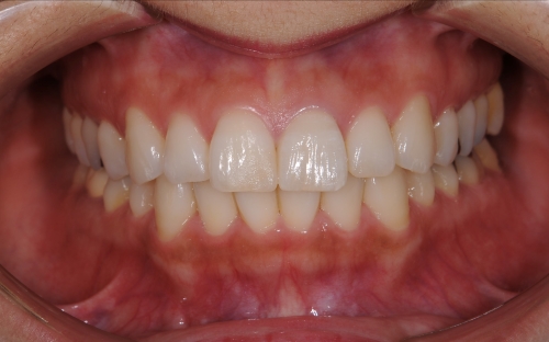 セラミック治療後の口内