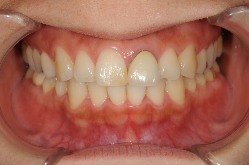 セラミック治療前の口内