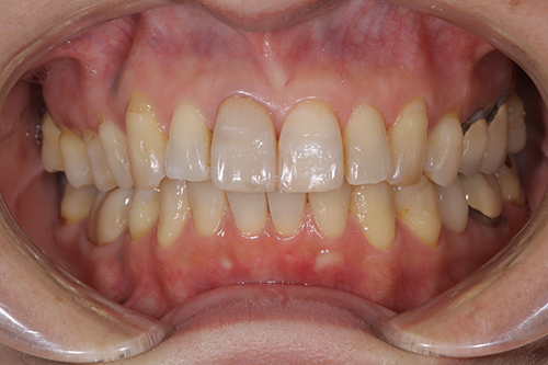 セラミック治療後の口内