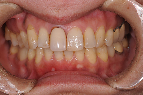 セラミック治療前の口内