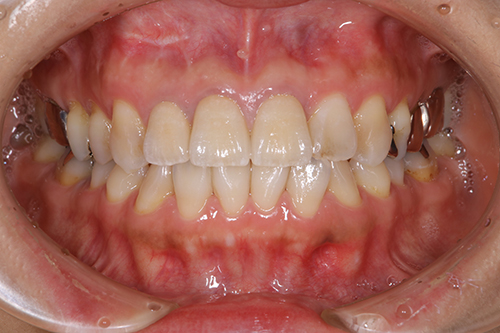 セラミック治療後の口内