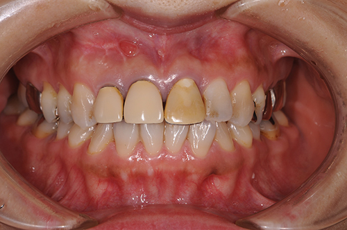 セラミック治療前の口内
